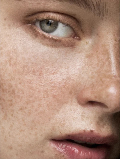 Hyperpigmentation